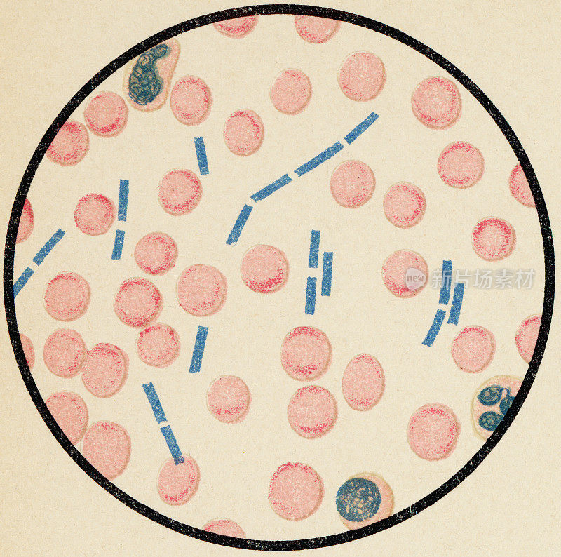 从最近死于炭疽的病人的人体血细胞显微镜观察，革兰氏染色法- 19世纪